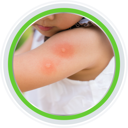 Stretch marks can be helped with Bepanthen Stretch Mark Cream